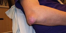 痛風結節の治療